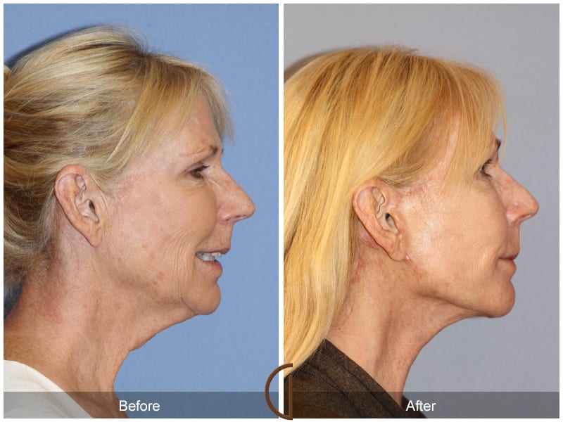 Facelift Costa Mesa Image
