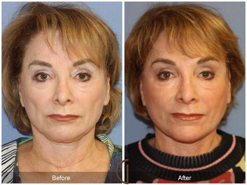 Facelift Anaheim 445 Image