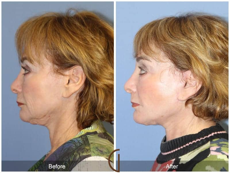 Facelift Anaheim 445 Image