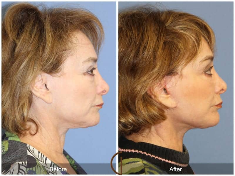 Facelift Anaheim 445 Image