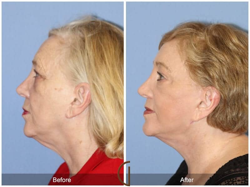Facelift Before and After Orange County Image