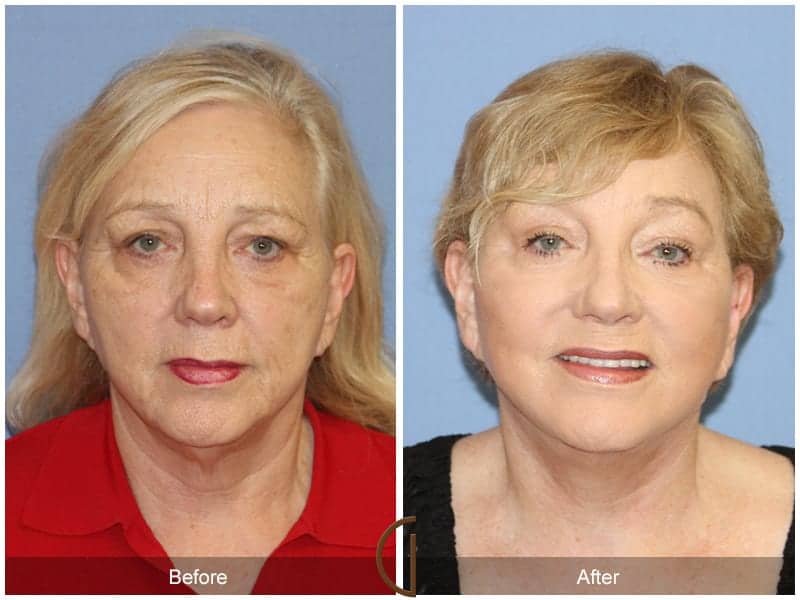 Facelift Before and After Orange County Image