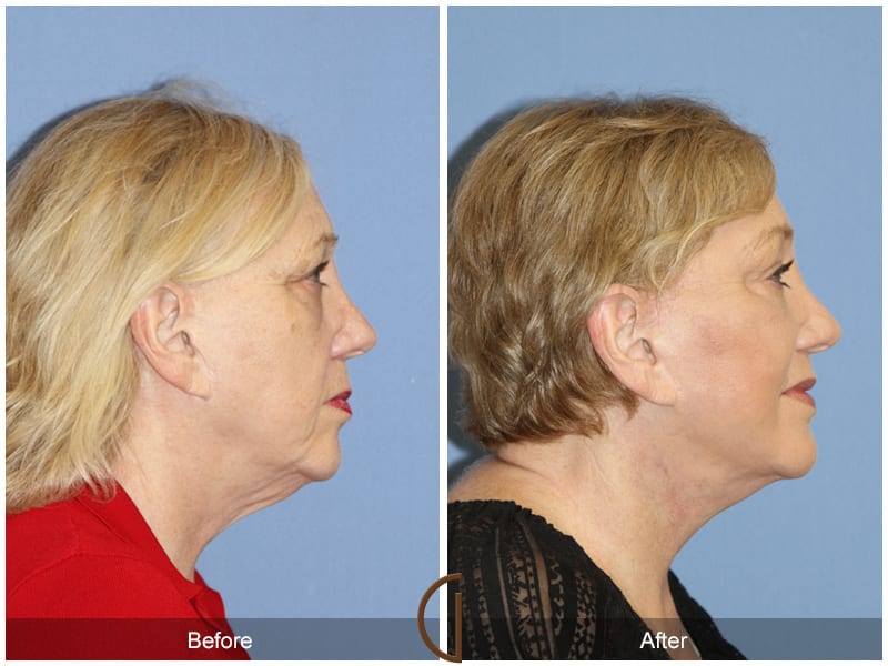 Facelift Before and After Orange County Image