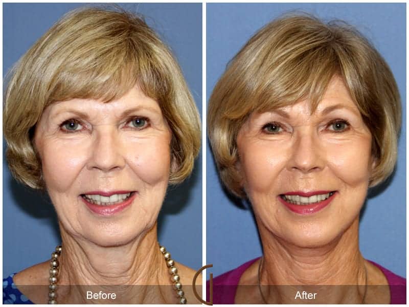 Facelift Huntington Beach Image