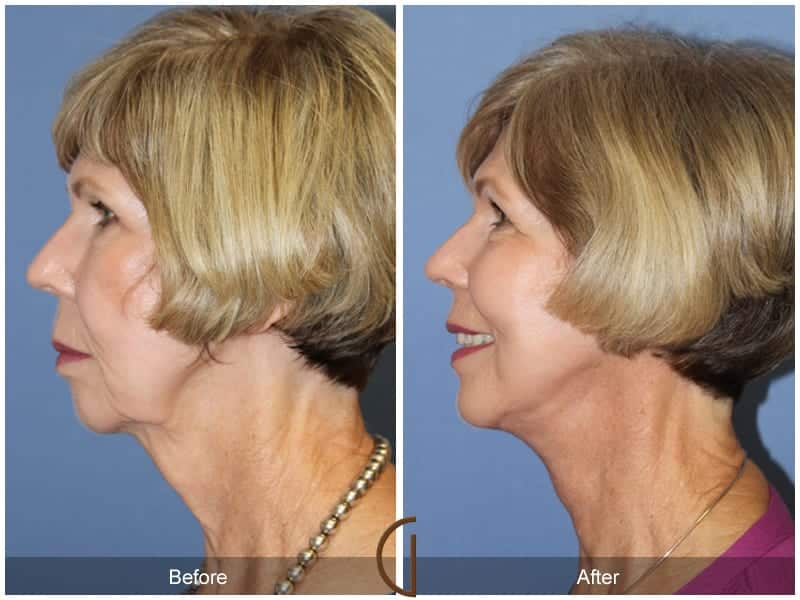 Facelift Huntington Beach Image