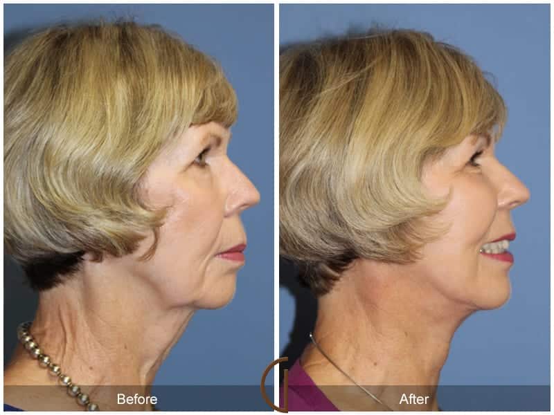 Facelift Huntington Beach Image