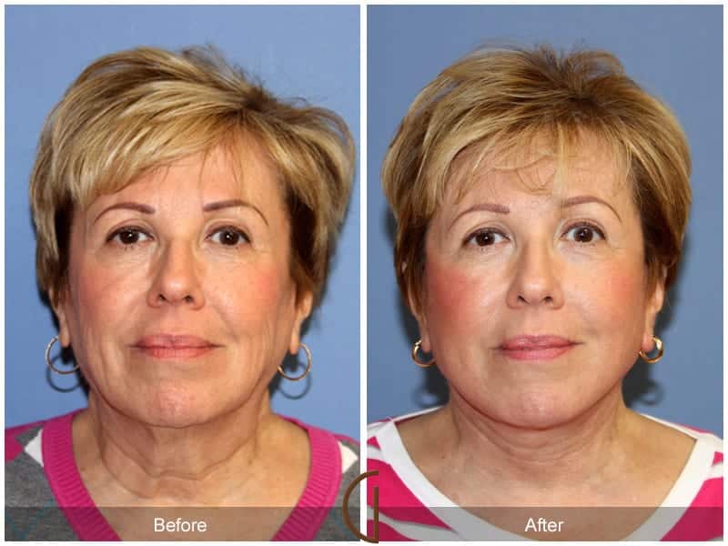 Facelift Irvine Image