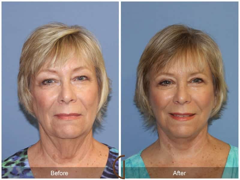 Facelift Laguna Beach Image