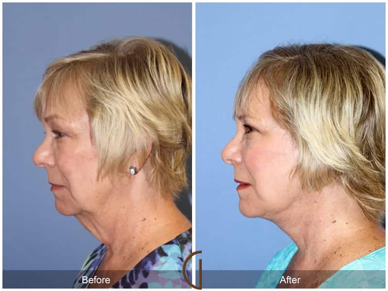 Facelift Laguna Beach Image