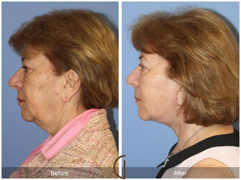 Facelift Orange County Image