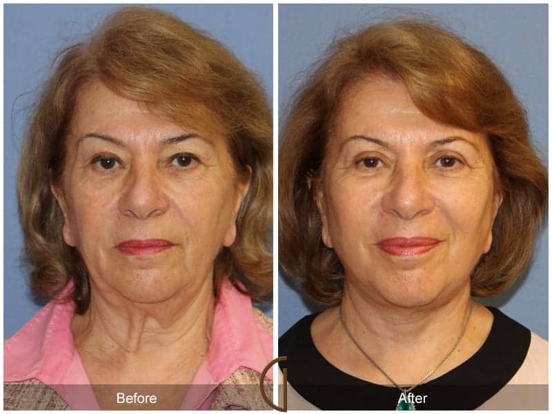 Facelift Orange County Image