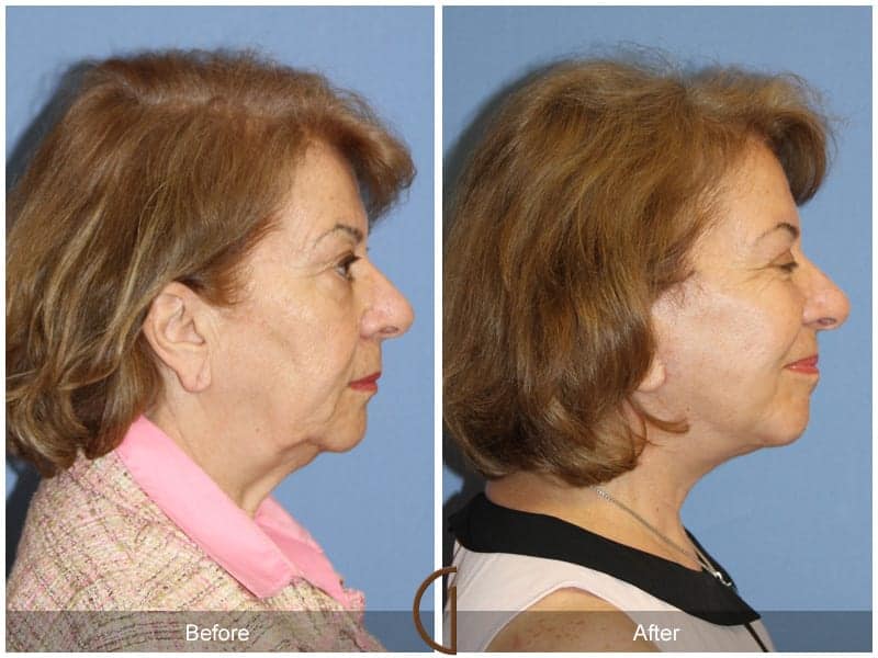 Facelift Orange County Image