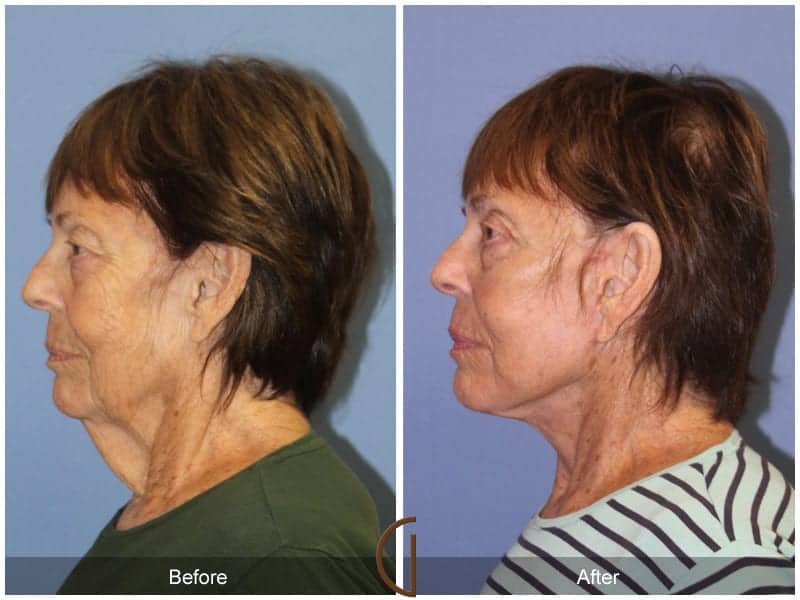 Facelift Surgeon Orange County Image