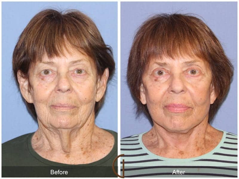 Facelift Surgeon Orange County Image
