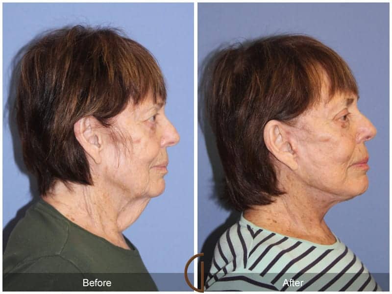 Facelift Surgeon Orange County Image