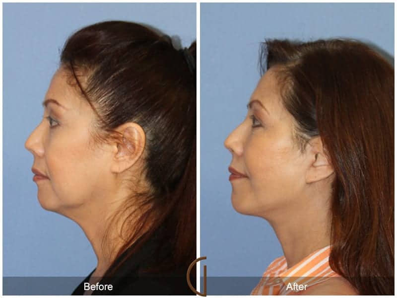 Facelift Surgery Beverly Hills Image