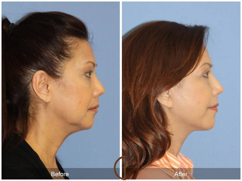 Facelift Surgery Beverly Hills Image