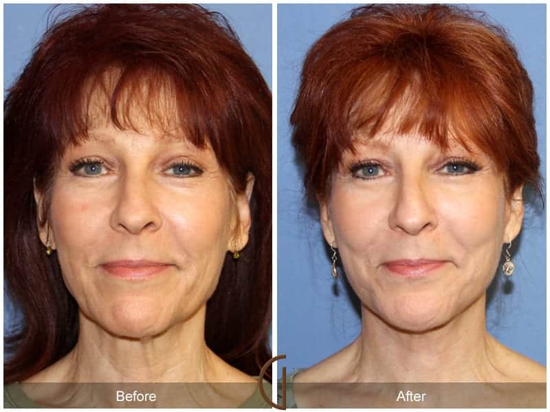 Facelift Surgery Orange County Image