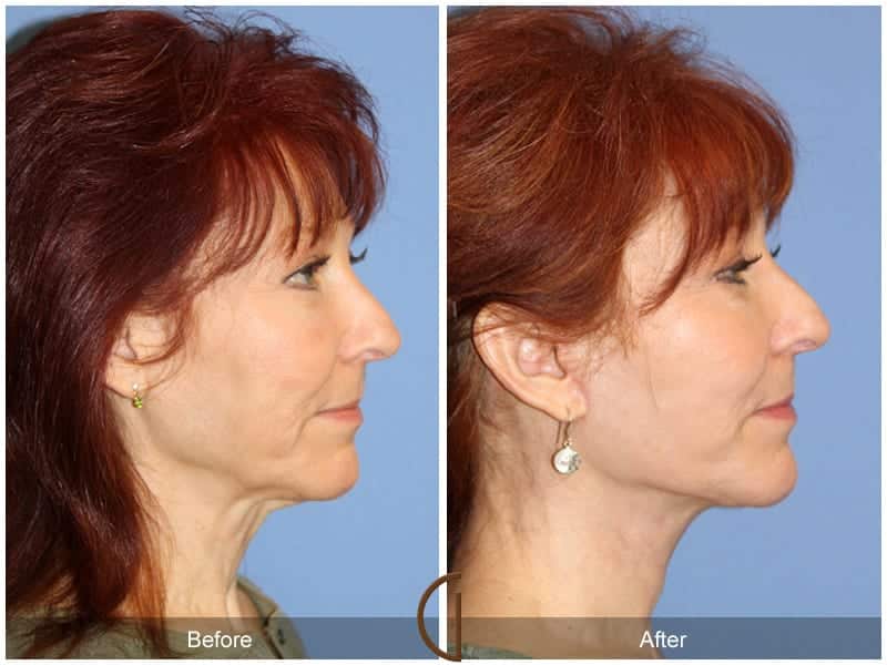 Facelift Surgery Orange County Image
