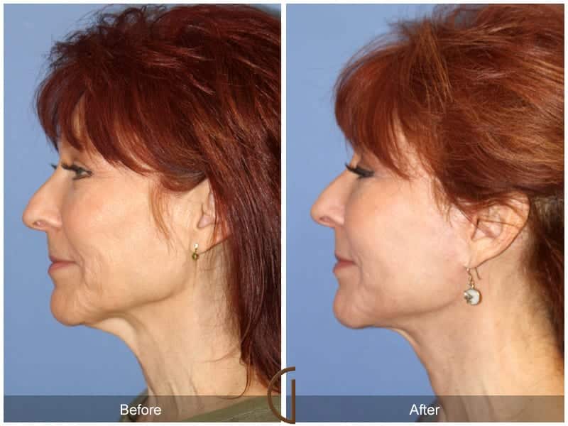 Facelift Surgery Orange County Image