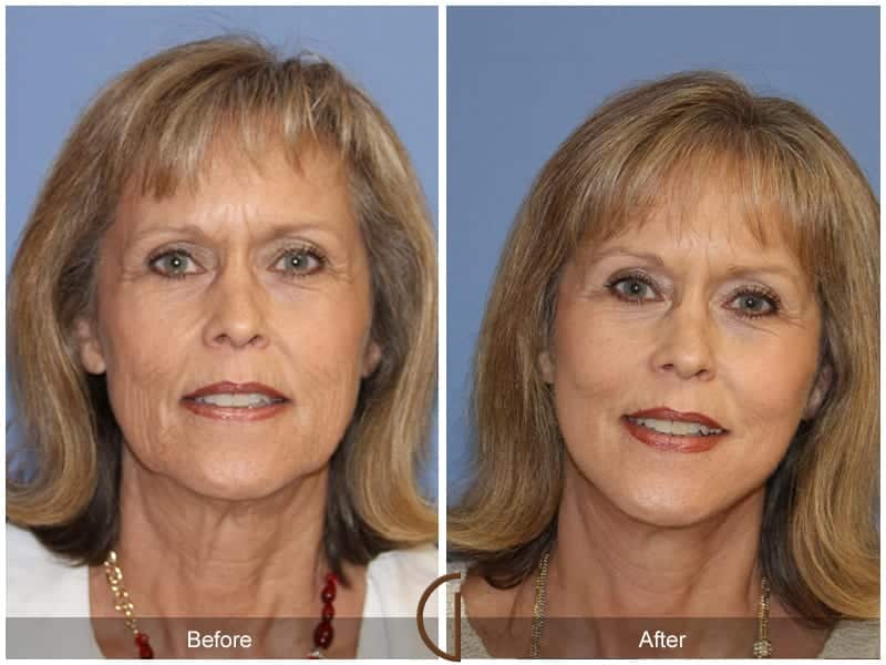 Facelift Tustin Image
