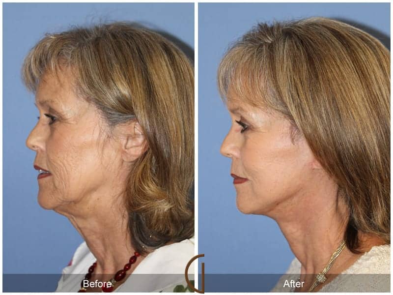 Facelift Tustin Image