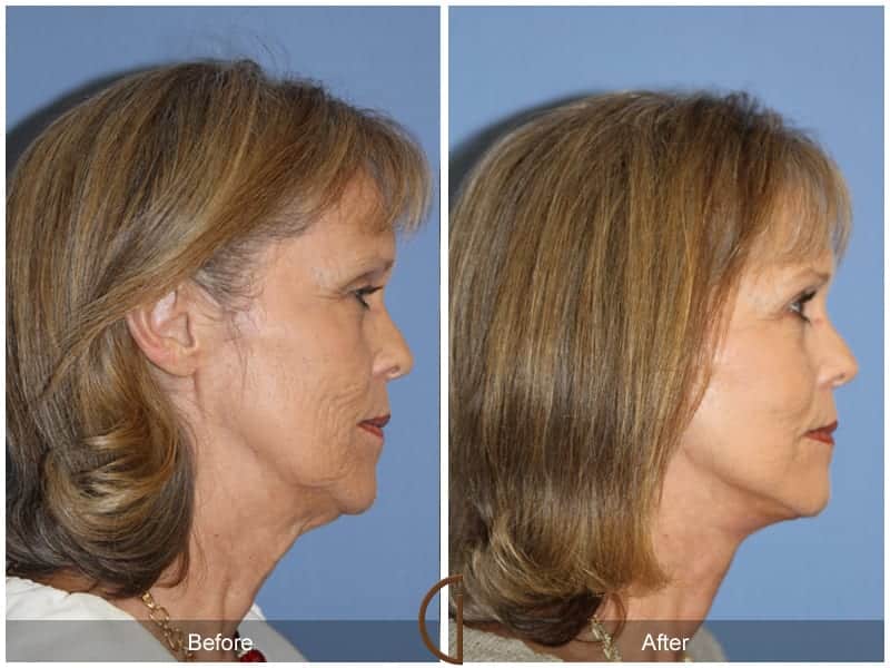 Facelift Tustin Image