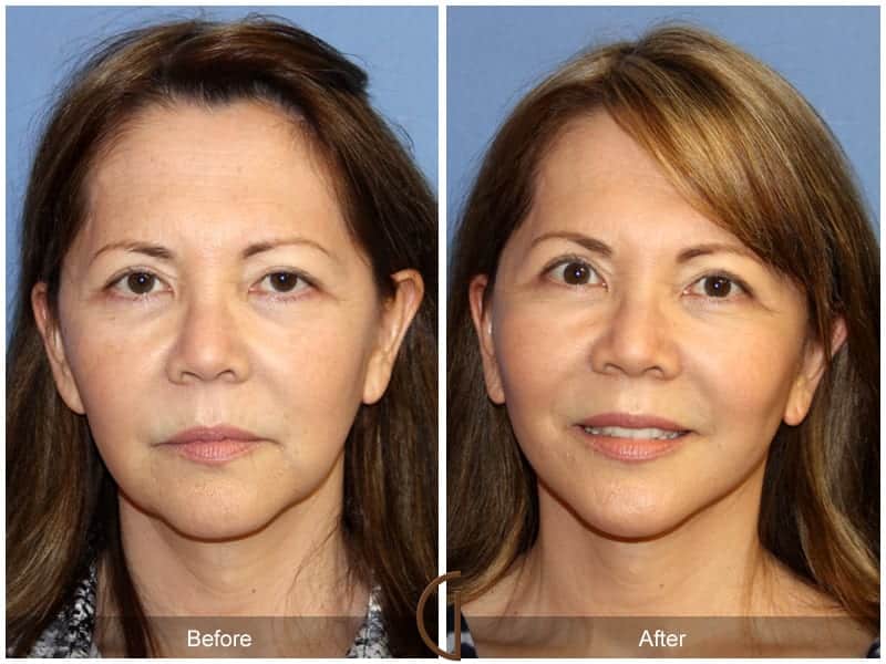 Facelift Costa Mesa 10102 Image