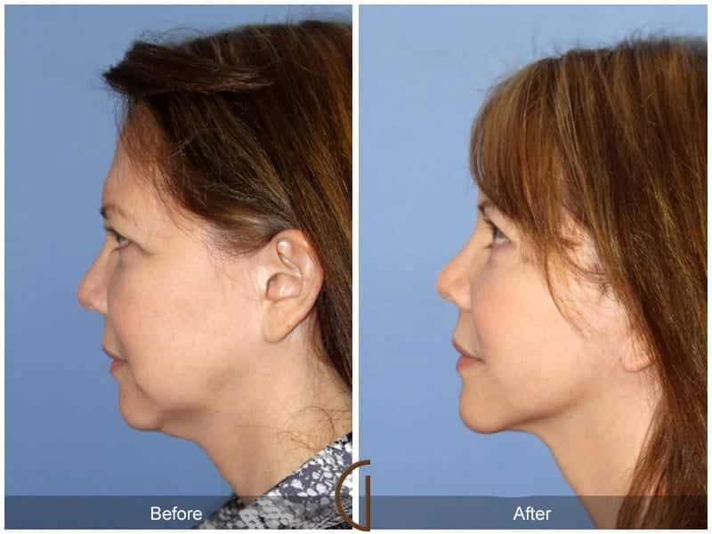 Facelift Costa Mesa 10102 Image