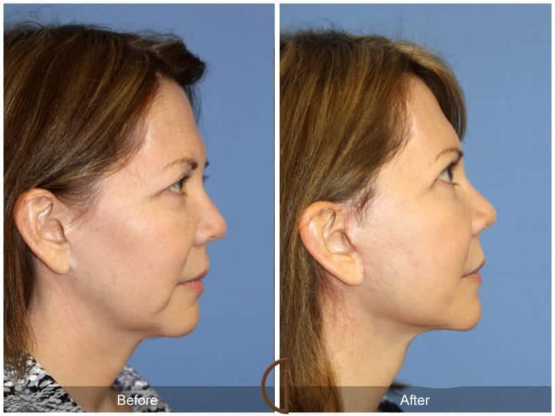 Facelift Costa Mesa 10102 Image