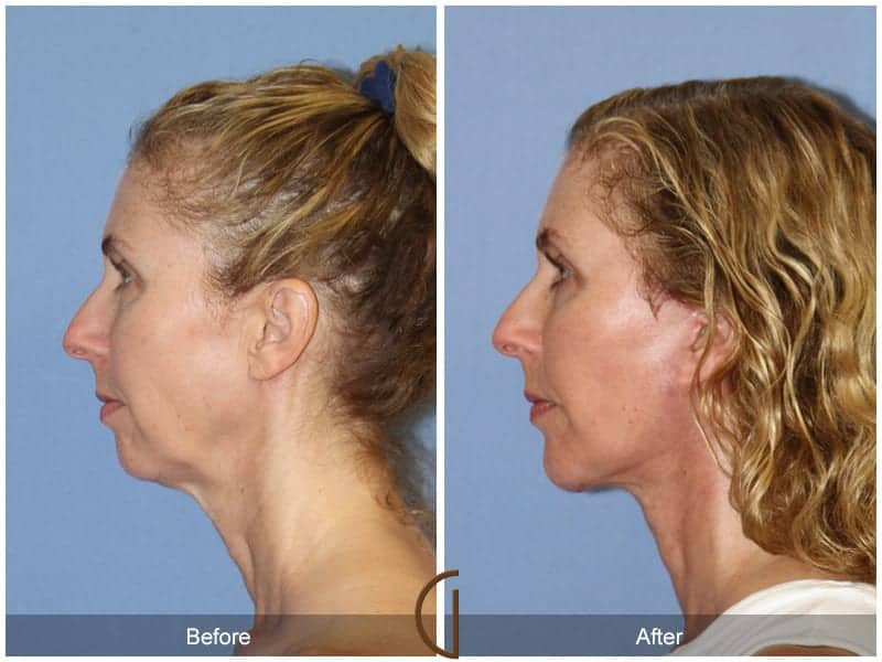 Facelift Surgery Anaheim Image