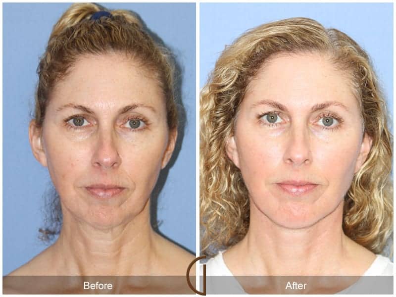Facelift Surgery Anaheim Image