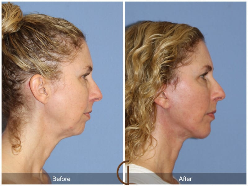 Facelift Surgery Anaheim Image