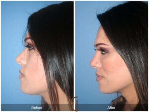 Facial Fat Grafting Anaheim CA
