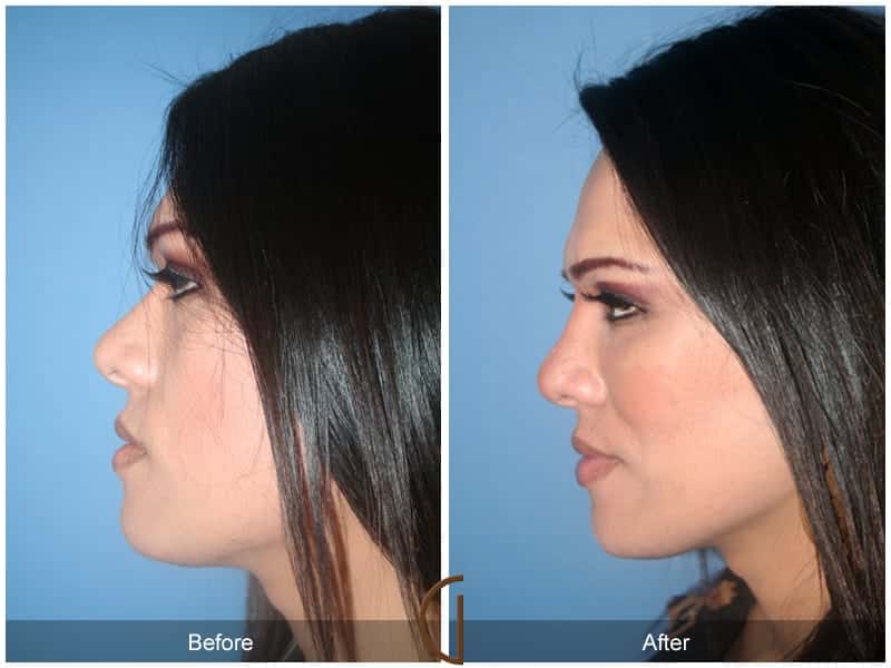 Facial Fat Grafting Anaheim CA 7 Image
