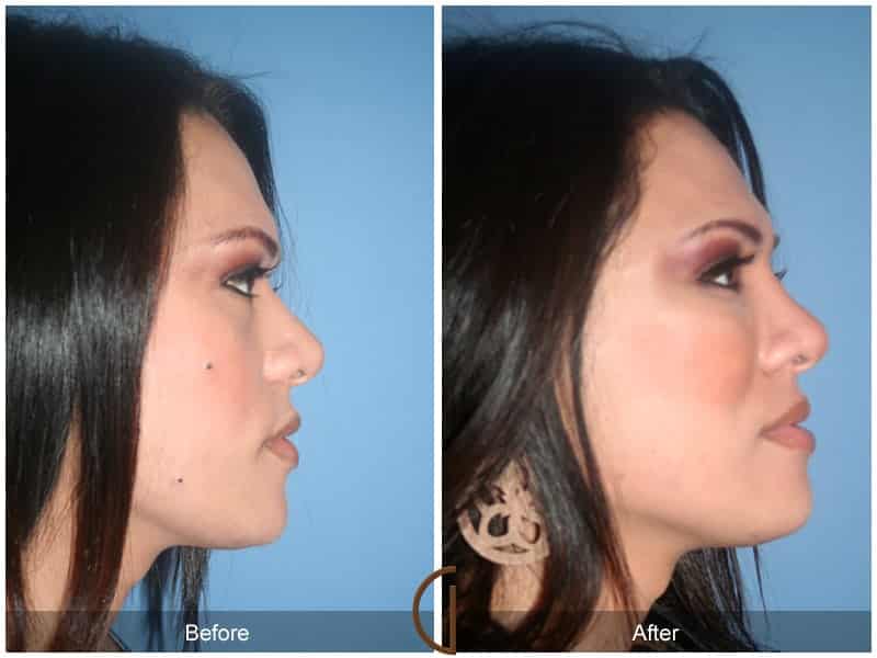 Facial Fat Grafting Anaheim CA 7 Image