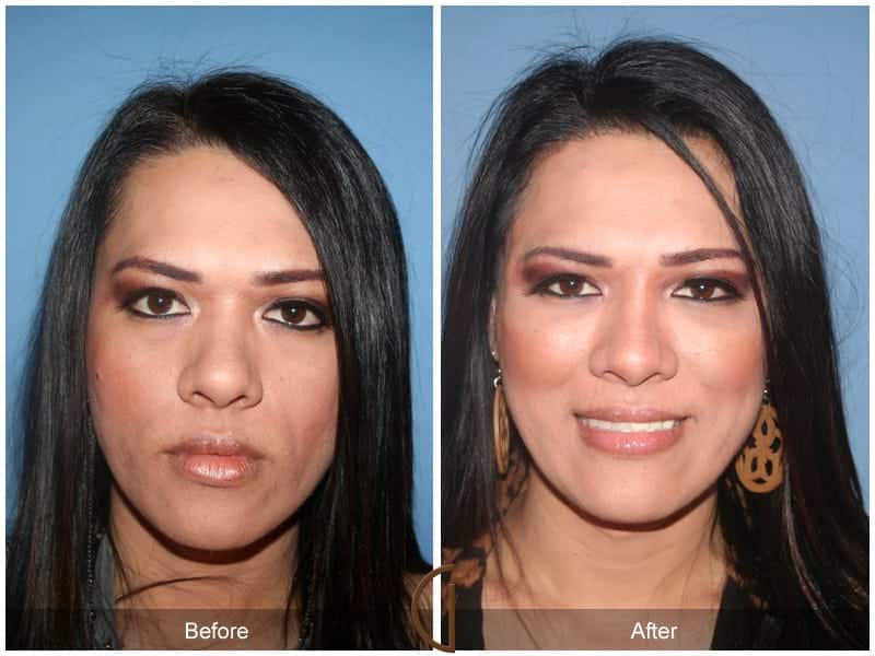 Facial Fat Grafting Anaheim CA 7 Image