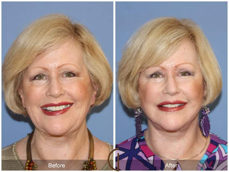 Facial Fat Grafting Buena Park CA 19 Image