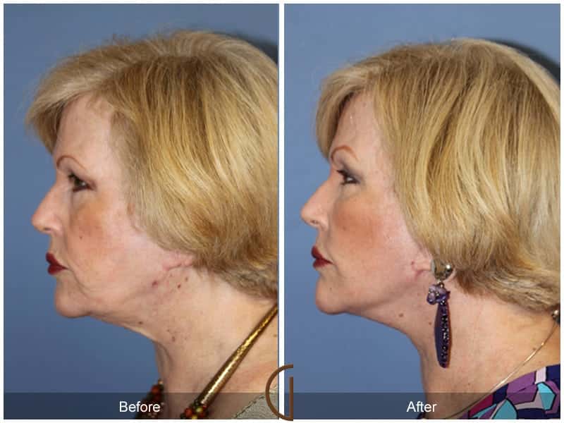 Facial Fat Grafting Buena Park CA 19 Image