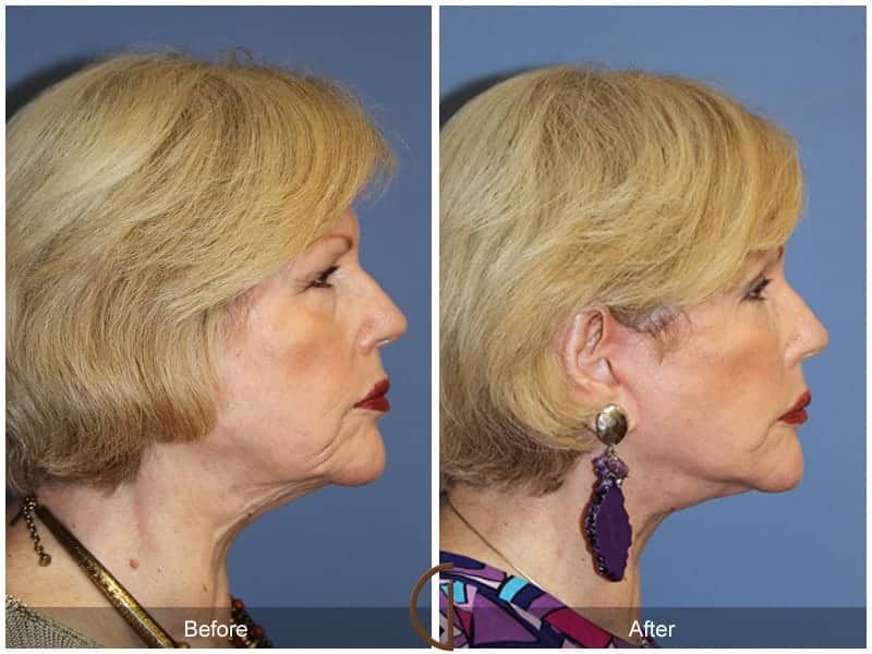 Facial Fat Grafting Buena Park CA 19 Image