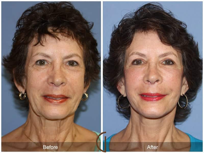 Facial Fat Grafting Costa Mesa CA 20 Image