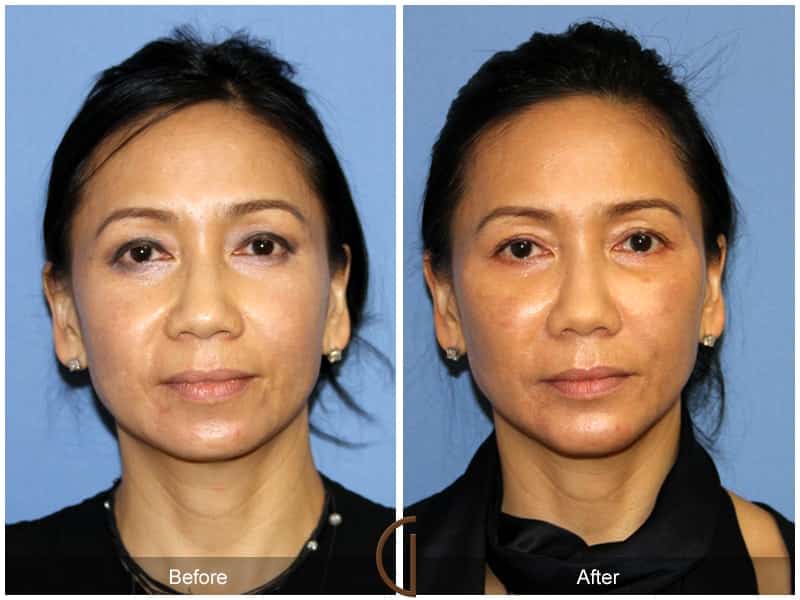 Facial Fat Grafting Costa Mesa CA 59 Image