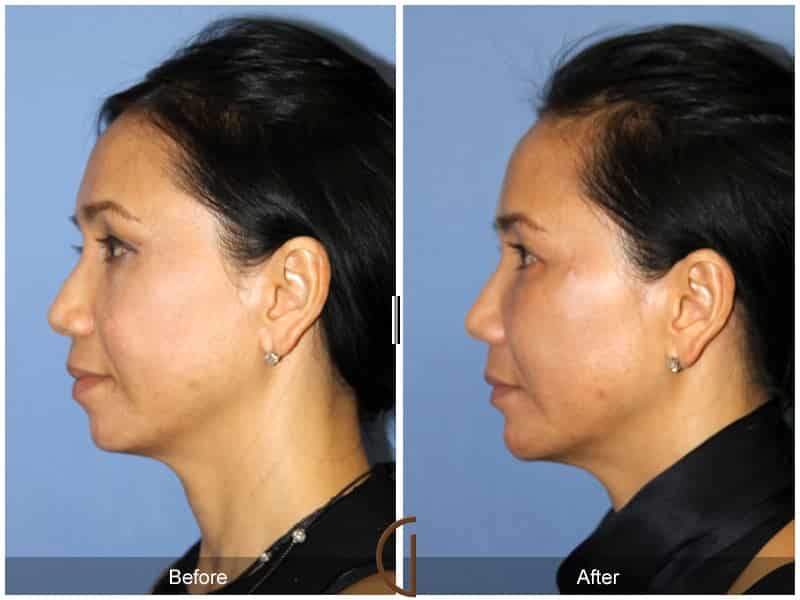 Facial Fat Grafting Costa Mesa CA 59 Image