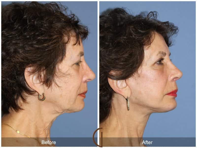 Facial Fat Grafting Costa Mesa CA 20 Image