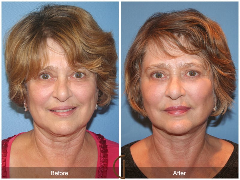 Facial Fat Grafting Coto de Caza CA 12 Image