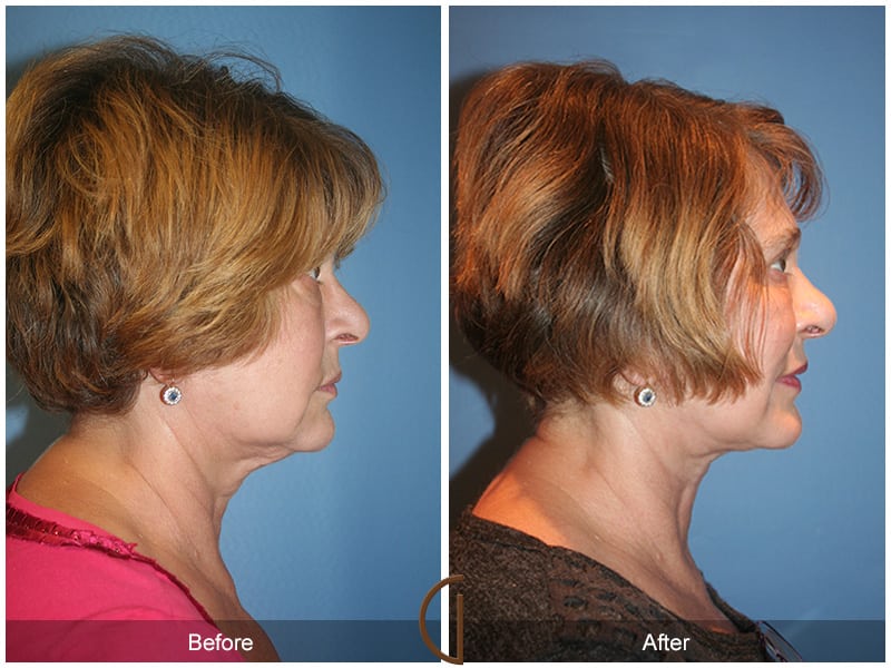 Facial Fat Grafting Coto de Caza CA 12 Image