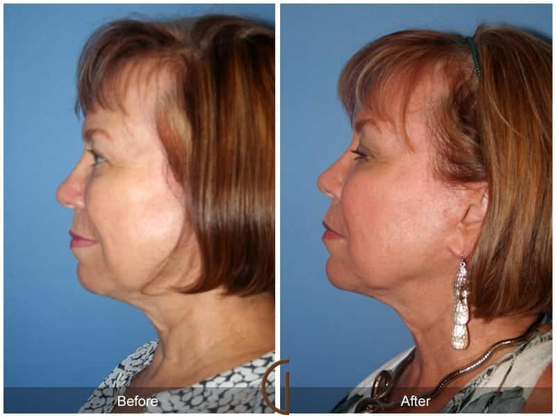 Facial Fat Grafting Dana Point CA 7 Image