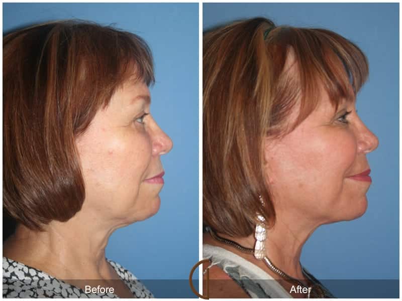 Facial Fat Grafting Dana Point CA 7 Image