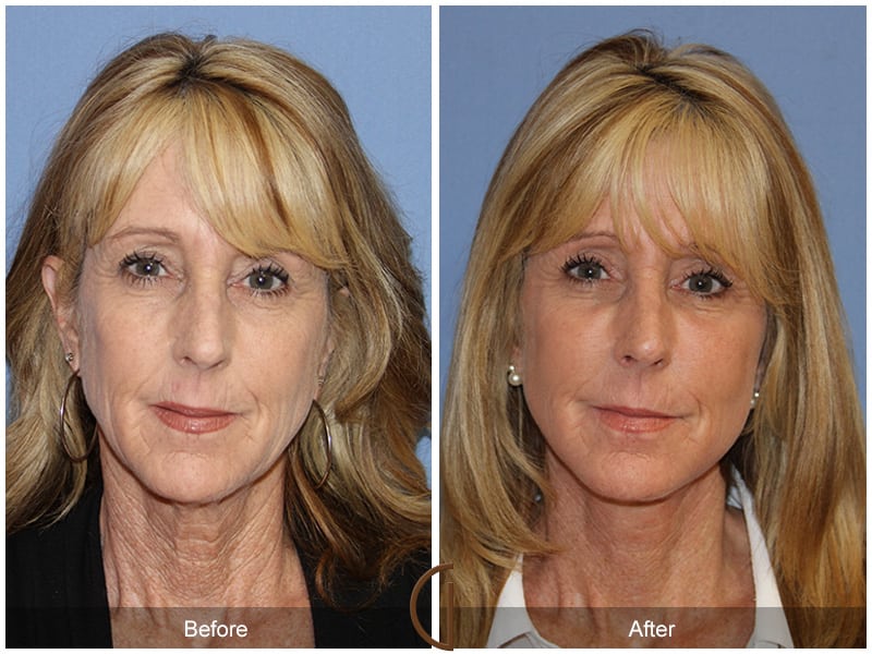 Facial Fat Grafting Irvine CA 53 Image