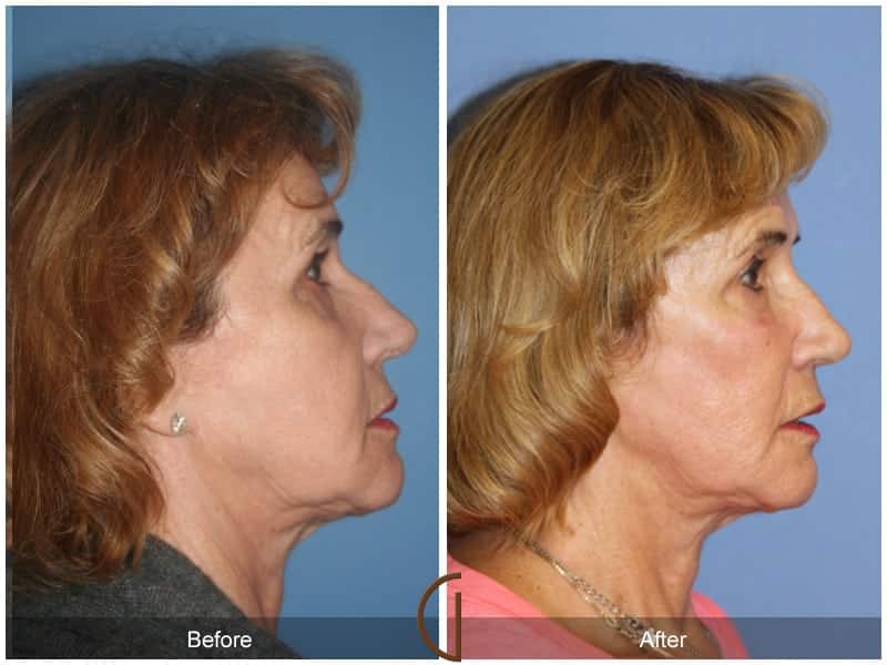 Facial Fat Grafting Ladera Ranch CA 18 Image